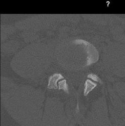 bilateral l5 spondylolysis with an arrow delineating the pars defect