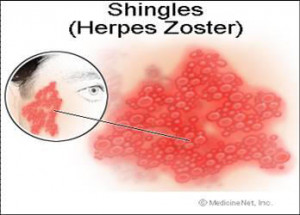 Early+shingles+rash+pictures