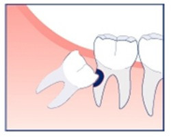 Impacted Wisdom Teeth Cavity