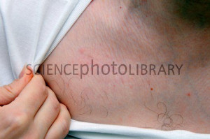 Occipital Nerve Stimulator Implant