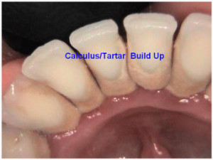 Dirty Teeth Linked Heart...