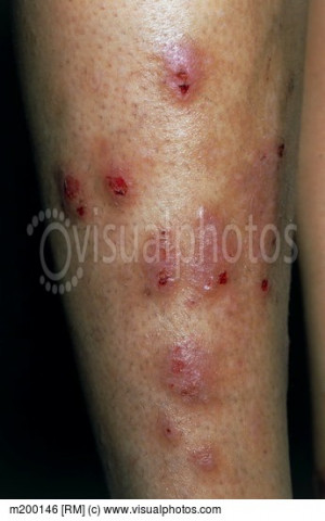 Lichen planus rash on a woman s legs