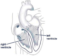 Life Insurance Rates for Heart Arrhythmias and Irregular Heart Beats