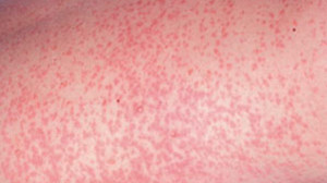 Rubella Measles Symptoms