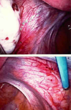 Mild endometriosis seen at laparoscopy