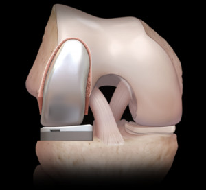 Partial knee replacement 2 large