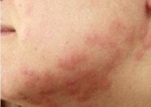 Les piqures des punaises de lit sont souvent rapprochées les unes des ...