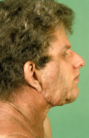 Neurofibromatosis Images