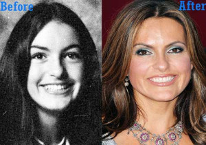 Plastic Surgery Before After