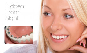 lingual braces hidden from sight lingual braces are a great aesthetic ...