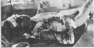 bomb victim lies in quarantine on the island of Ninoshima in Hiroshima ...