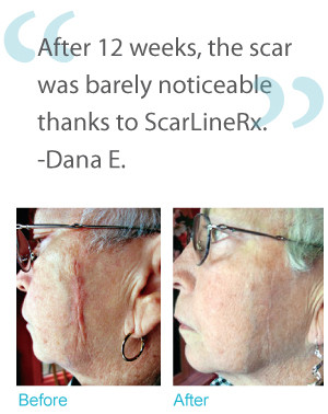 What Is ScarLine Rx ®
