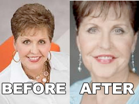 Joyce Meyer Plastic Surgery Gone...