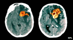The brain tumours could be detected in the blood.