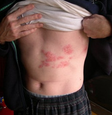 ... shingles skin cincinnati female news reporters shingles and jury duty