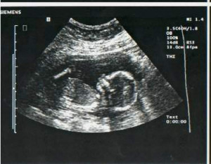 17 Weeks Pregnant Ultrasound Picture