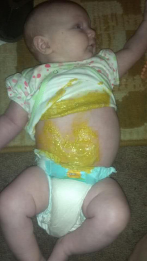 Milk Allergy Baby Poop