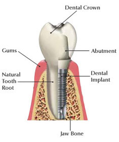 Dental Implant Diagram
