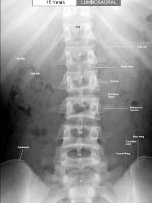 ray Lateral Lumbar Spine Anatomy