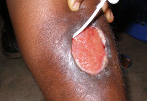 Small Skin Ulcers