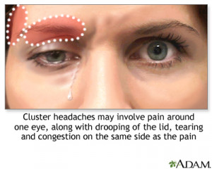 Headaches - cluster