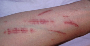 Self-inflicted scratches from a knife