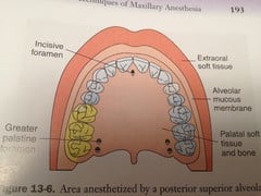 Posterior Superior Alveolar Injection: area anesthetized