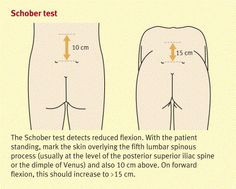 auto immune ankylosing spondilitis spondylitis fibromyalgia ankylosing ...