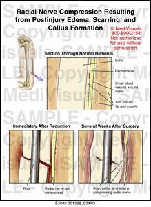 Radial Nerve Compression
