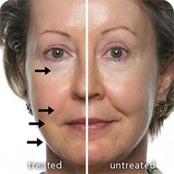 Nu Skin Galvanic Spa Facial Before And After