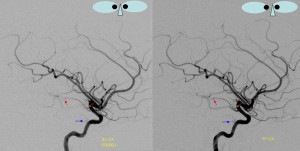 anterior choroidal artery territory