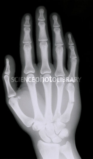 Rays Of Broken Bones http://www.sciencephoto.com/media/263941 ...