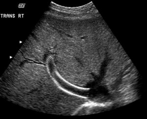 Liver Tips Ultrasound