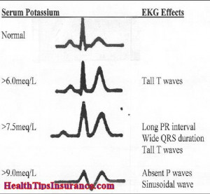 ELECTROLYTE IMBALANCE - HYPERKALEMIA