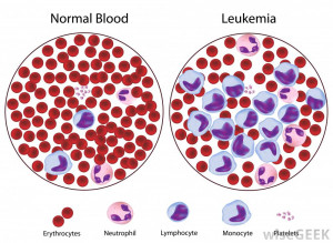 ... of leukemia a disease that may cause a low white blood cell count