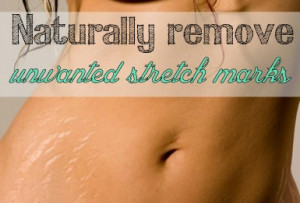 Naturally-remove-unwanted-stretch-marks.jpg