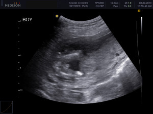 Weeks Pregnant Ultrasound...