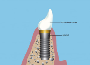Parts of Dental Implant Screw Diagram