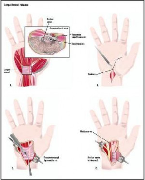 carpal tunnel Images and Graphics