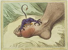 1799 cartoon depicting gout.