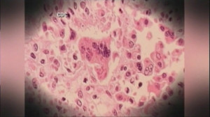 Measles Koplik Spots In