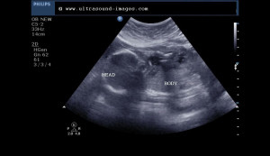 Oligohydramnios Ultrasound Images