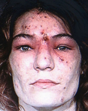Meth Sores On Face