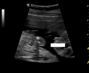 Week Ultrasound Tech Was Uncertain Please Help Gender