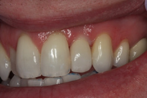 Teeth (such as bridges, endosteal implants , partial dentures, and ...