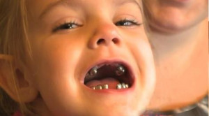 Savannah White, age 4, was given all silver caps on her teeth when her ...