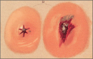 Paintings of wounds made by a conical bullet in a Civil War casualty ...