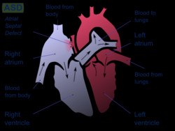 Atrial septal defect - Wikipedia, the free encyclopedia