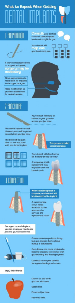 Dental implants offer numerous benefits! Patients who get these dental ...