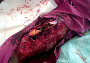 Broken Femur Compound Compound femoral fracture
